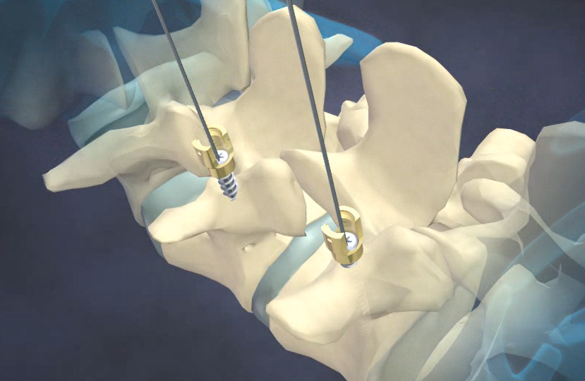 back surgery animation for use in a trial